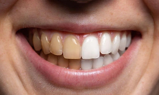 10 ways to effectively remove coffee stains from teeth